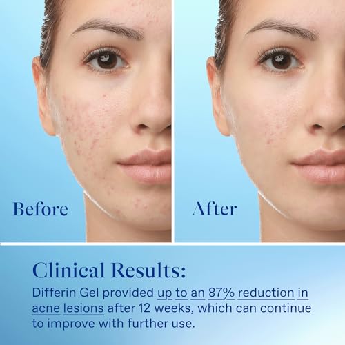 Differin Acne Treatment Gel, 30 Day Supply, Retinoid Treatment for Face with 0.1% Adapalene, Gentle Skin Care for Acne Prone Sensitive Skin, 15g Tube (Packaging May Vary) - Image 6